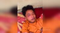 Luka Memar di Wajah Korban Penganiayaan Akibat Nabrak Pohon